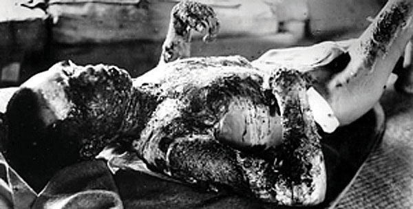 A disturbing picture of a man who was injured by the dropping of an atomic bomb. His skin is badly burned