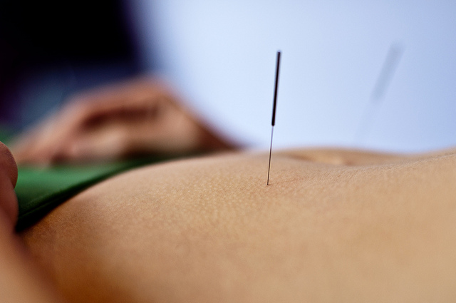 A woman receiving acupuncture