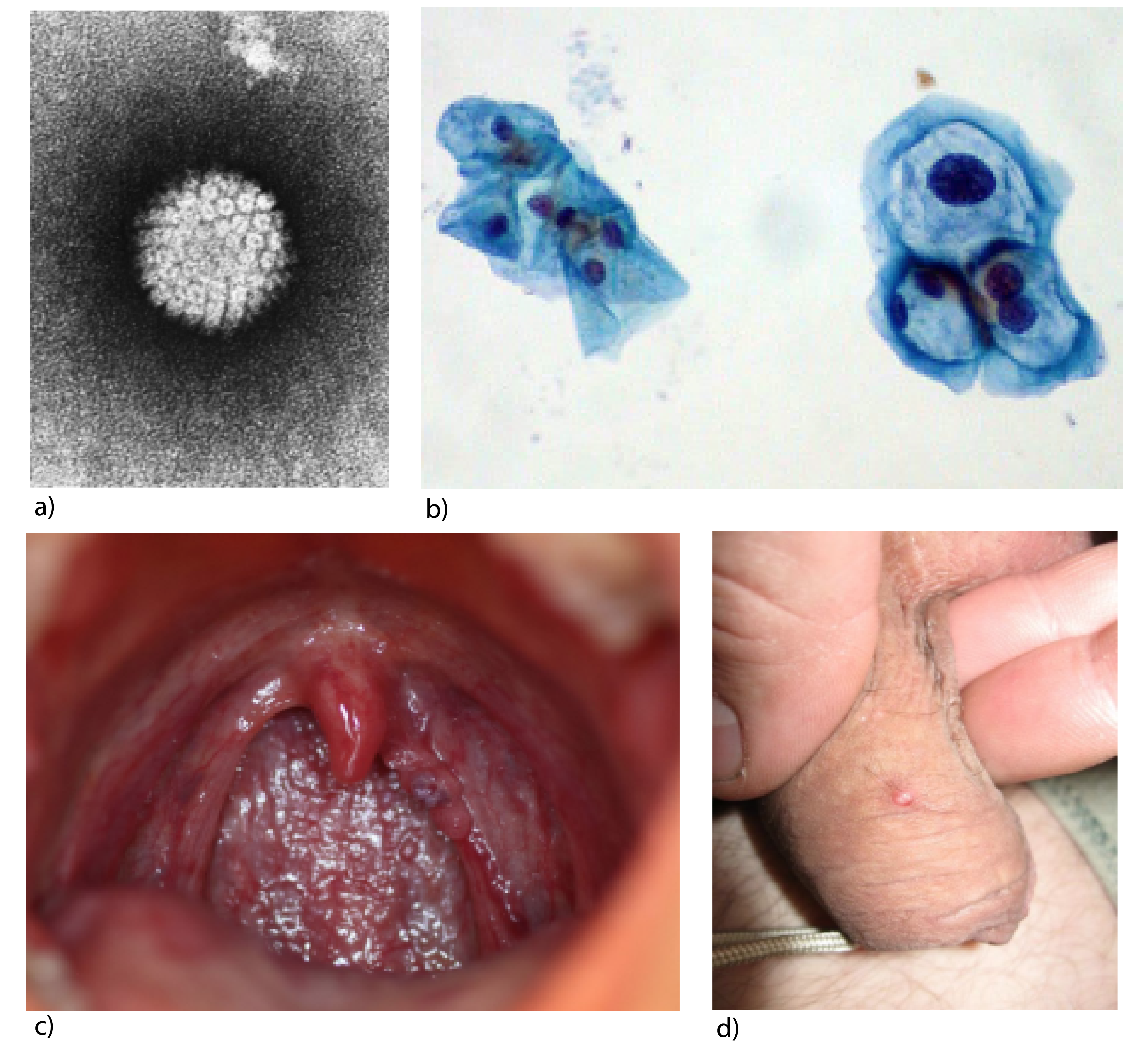 human papillomavirus disease