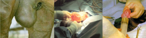 scrotal hydrocoele: enlarged scrotum, hydrocoele at surgery, hydrocoele being aspirated