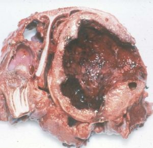 maxillary cyst