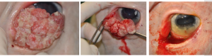 three images; the first shows a large SCC of the third eyeldi, the second is in the process of removal and the third after ti has been removed