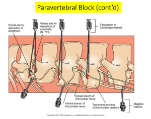 paravertebral block