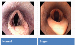 normal-epiglottis is scalloped and vessels visible; Bugsy - epiglottis covered with a sleeve of tissue