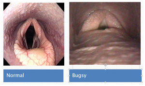 abnormal epiglottis is not visible due to a shelf of tissue