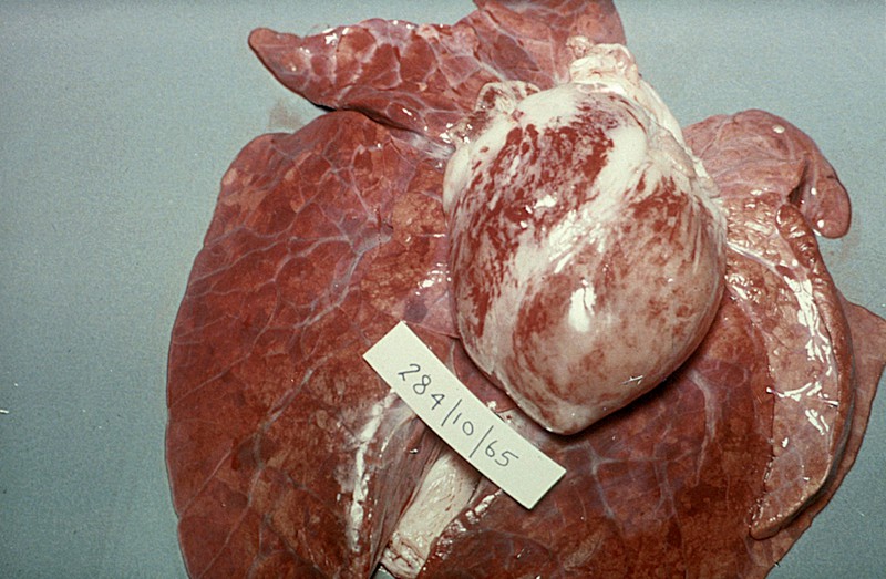 hemorrhage on the surface of the heart