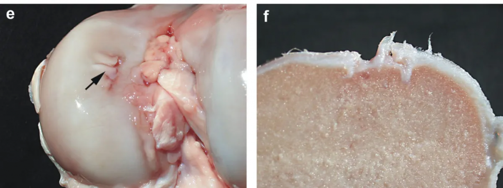 Macroscopic lesions of Osteochondrosis dissecans on the articular surface