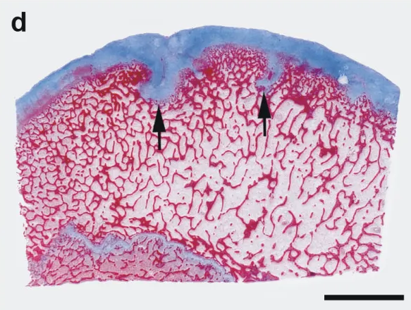 Microscopic lesion of osteochondrosis