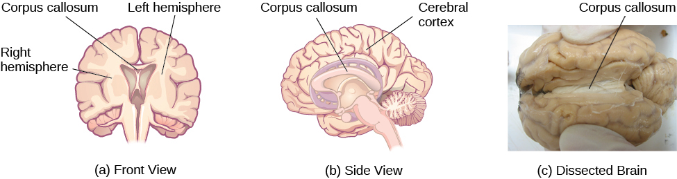 Illustrations (a) and (b) show the corpus callosum’s location in the brain in front and side views. Photograph (c) shows the corpus callosum in a dissected brain.