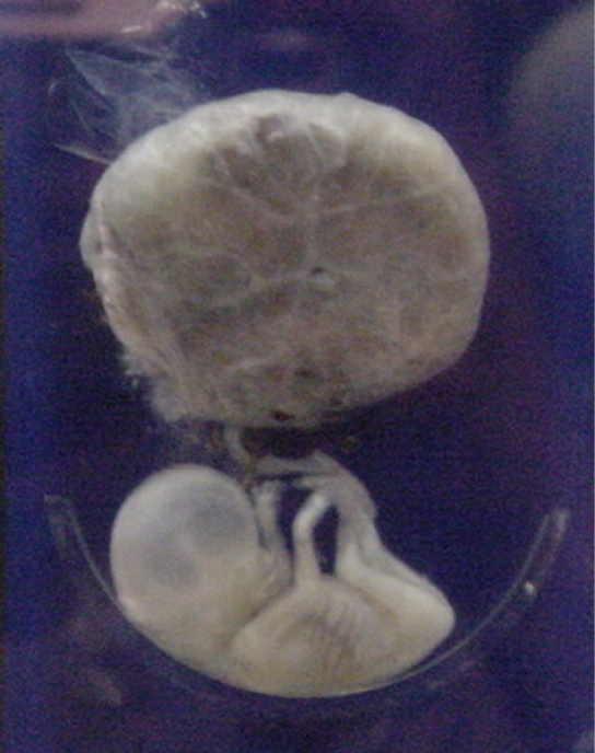The second trimester fetus has long arms and legs, and is attached to the placenta, which is round and larger than the fetus.
