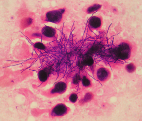 Cytology sample from an animal with actinomycetic mycetoma caused by a Nocardia sp. organism