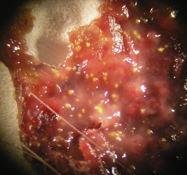 Microscopic characteristic of exudate from an actinomycetic mycetoma caused by Nocardia spp.
