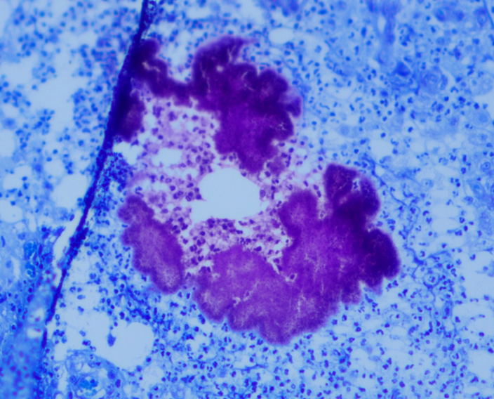 Microscopic characteristic of a tissue granule from exudate collected from a cat with mycetoma. The granules constitute aggregates of microorganisms (Gram stain).
