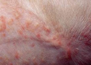 erythematous papules