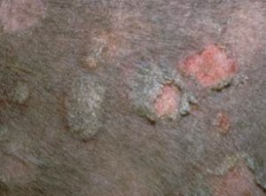 Exquisite epidermal collarettes