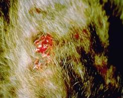 Ulcer