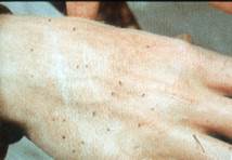 Various Culicoides midges on the back of a human hand