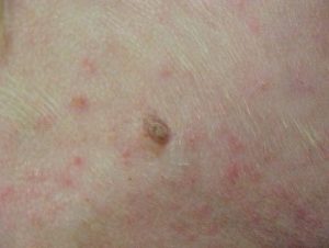pink spots and a brown dot on tan skin