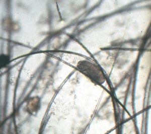 microscopic image of small oval brown egg underneath strands of hair