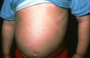 small red dots scattered across a person's stomach; person standing wearing red pants and blue t-shirt risen up