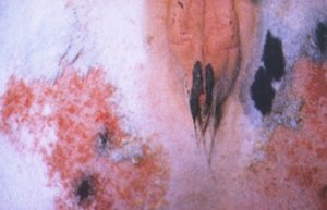 red splotches and black spots near perineum of white cattle