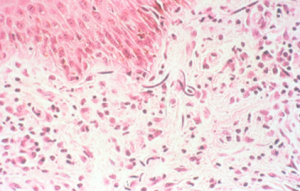 microscopic image of purple and pink colored microfilariae