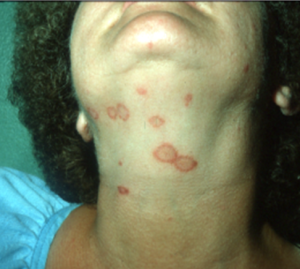 person lifting their head up to show signs of dermatophytosis on their neck