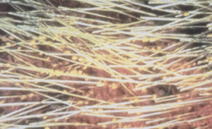 black lice along yellow strands of hair