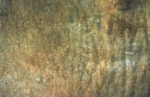 thick, hardened yellow and grey skin