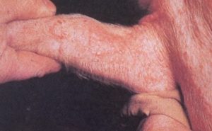 papules on pig's ear side profile