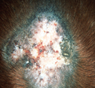 patch of white skin (hair loss) with red bumps surrounded by a blue-green outline