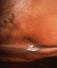 patch of white skin at horse's umbilical area