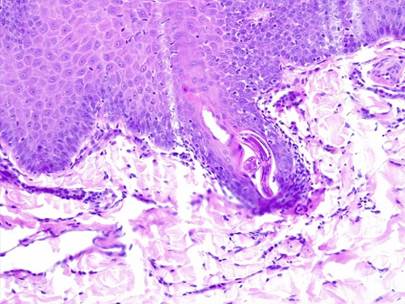 Skin biopsy (H&E stain) showing the larva of Pelodera strongyloides inside the hair follicle.