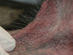 lichenified skin shown by thick, leathery texture and redness