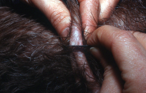 person pinching oily skin to collect sample with scalpel