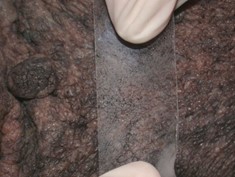 transparent cellophane tape being pressed onto lesional skin