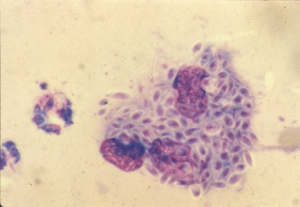 histopathology of Sporothrix schenckii; purple, cigar-shaped against a beige background