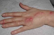 red bumps on a human's left hand