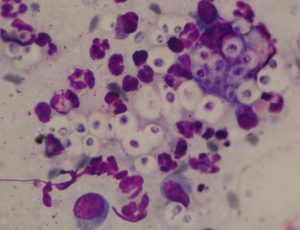 cryptococcal yeast cells in purple and white