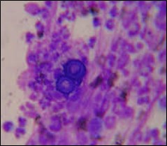 microscopic image of Blastomyces dermatitidis - clumps of purple cells