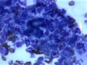 cytology of pyogranulomatous inflammation shown by purple clumps of cells