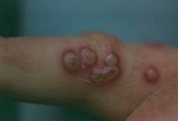 Classical ORF lesions on the finger of a person with poxviral infection.