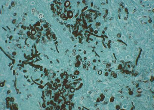 Grocott methenamine silver stain showing the fungal elements in black.