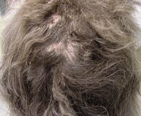 Dorsum of a Havanese dog with advanced sebaceous adenitis