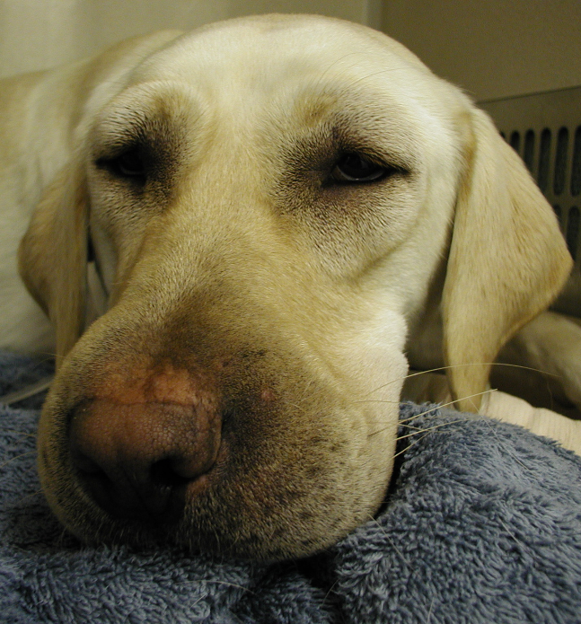 Angioedema caused by injectable penicillin.