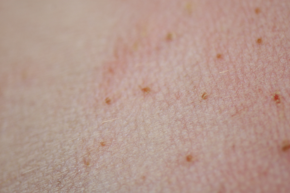 Multiple crusted papules on the abdomen of a dog being treated with carprofen to control lumbar pain. The skin lesions were generalized and the dog was lethargic, febrile, anorexic and had slightly swollen and painful joints. Peripheral lymphadenopathy was also present.